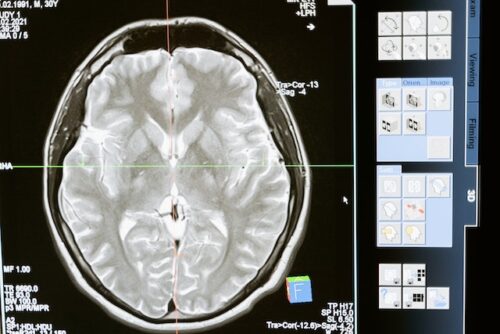 scan of a traumatic brain injury